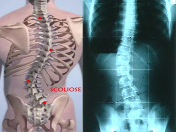 脊柱���：精�_一�c�碚f，脊柱���其��是一�N伴有椎�w旋�D的三�S脊柱畸形。